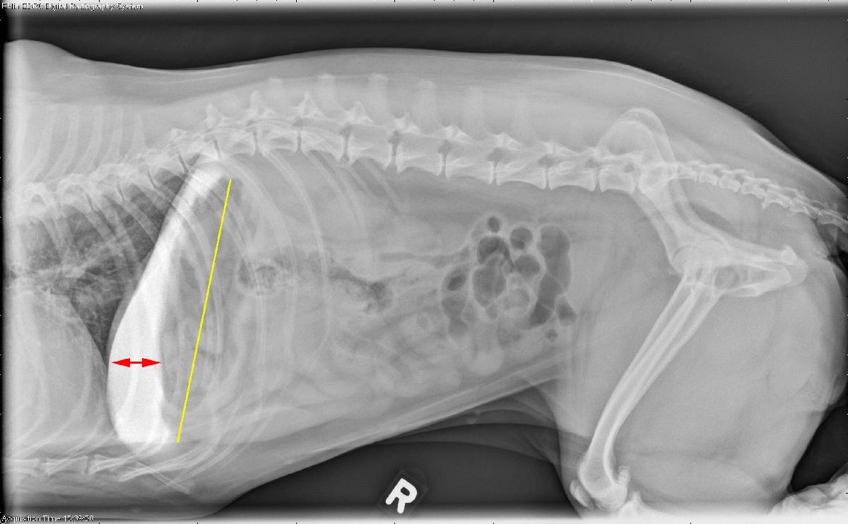 Microhepatia
