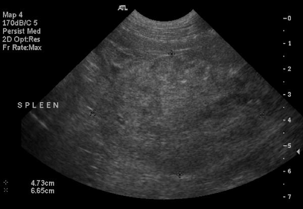 Hiatal Hernia